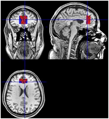 An MRI Study of the Metabolic and Structural Abnormalities in Obsessive-Compulsive Disorder
